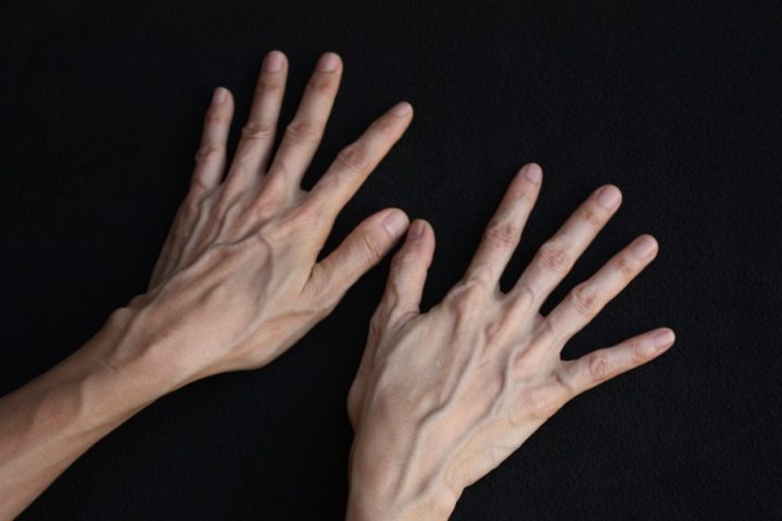 بازگشت زیبایی به دست‌ها با درمان واریس دست
