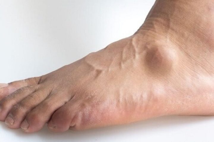 بهترین روش درمان ورم پا با توجه به علت ورم پا
