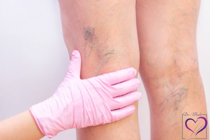 آشنایی با علائم واریس پا در زنان