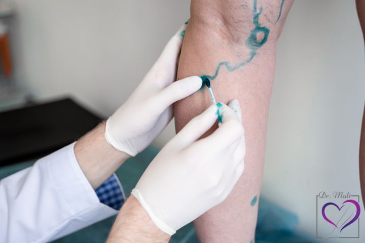 معجزه درمان واریس؛ بررسی 8 روش‌ درمانی پزشکی و خانگی واریس