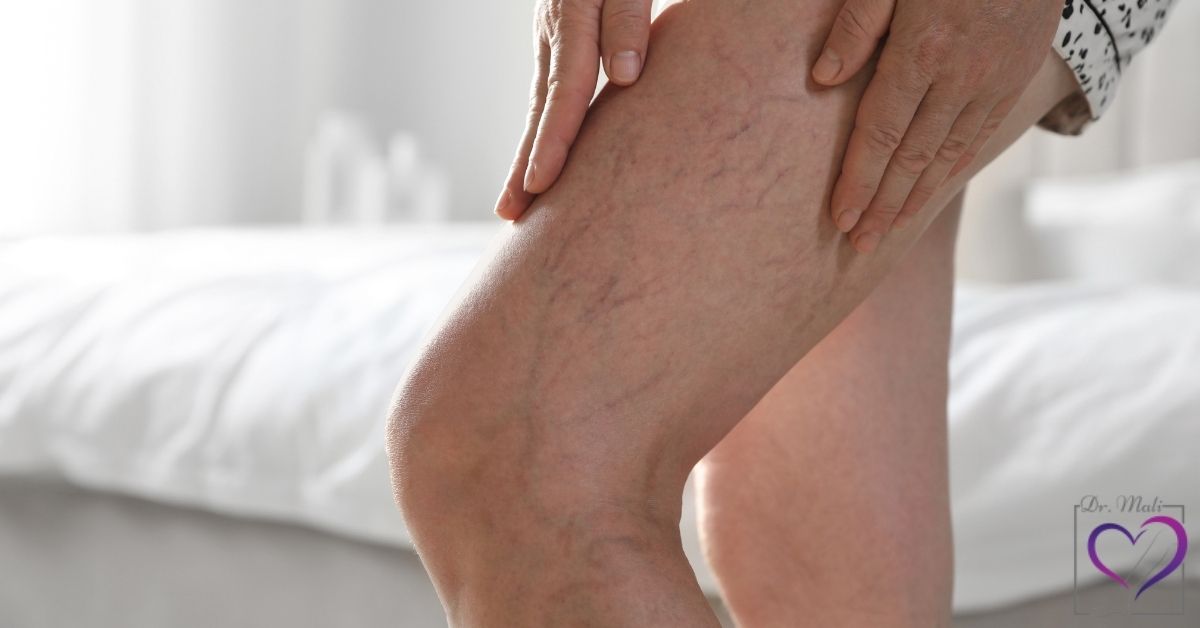 بهترین درمان برای رگهای واریسی