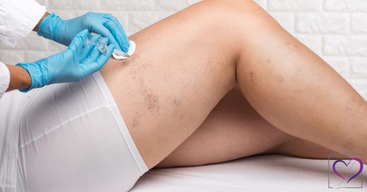 درمان سریع واریس؛ بررسی 6 روش درمانی اثبات شده