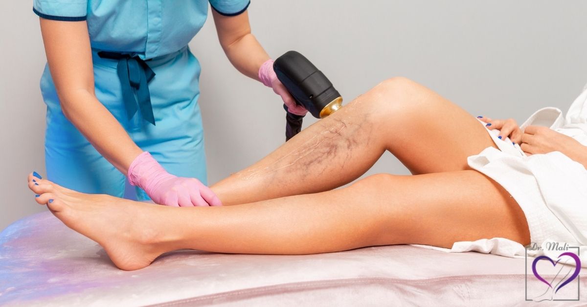 _درمان سریع واریس با لیزر