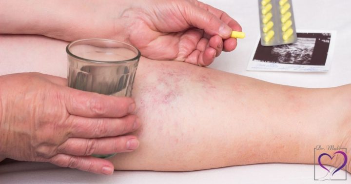 قرص واریس | بررسی انواع قرصهای درمان واریس