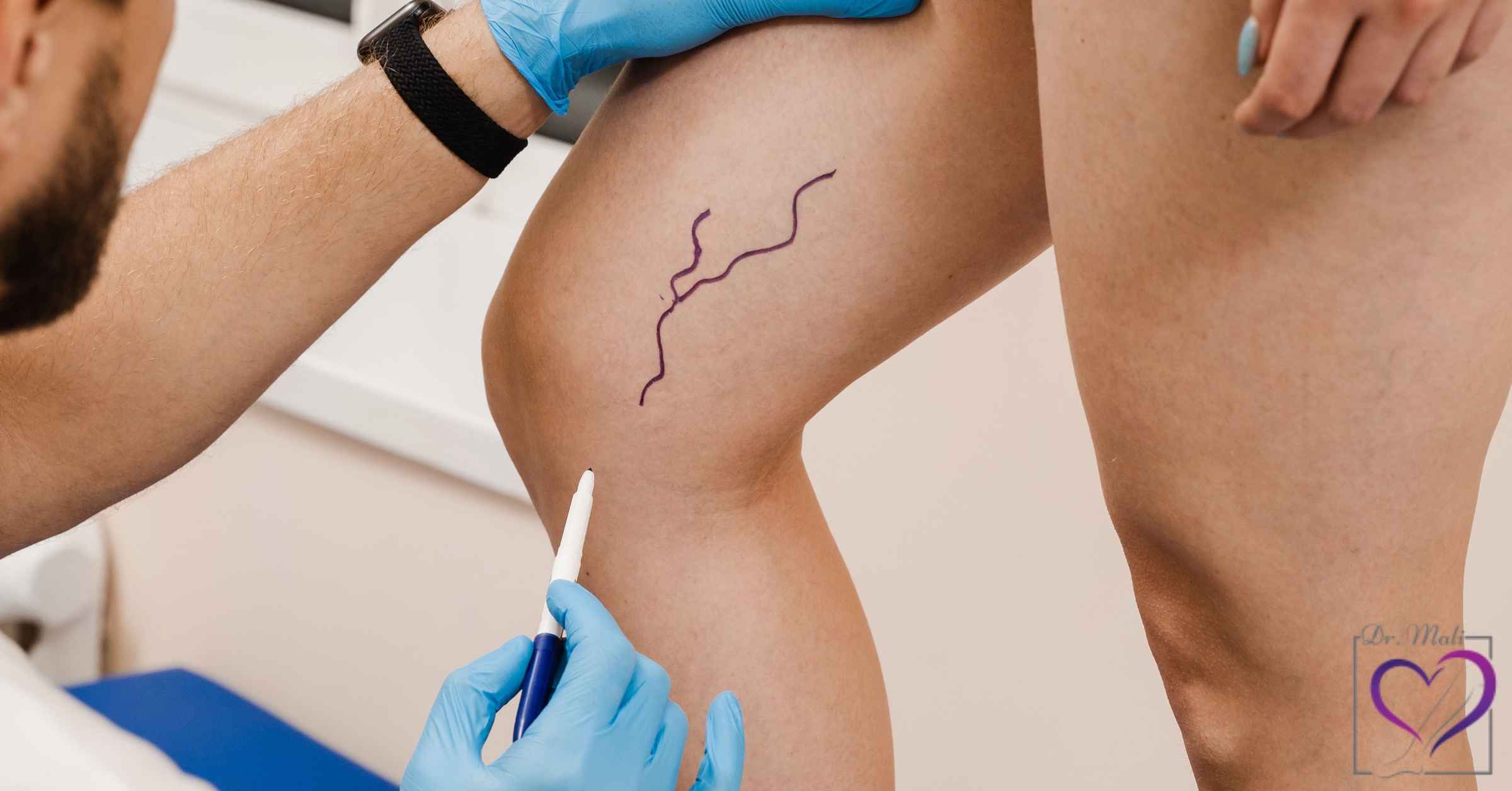 قبل و بعد از لیزر واریس چی کنیم؟