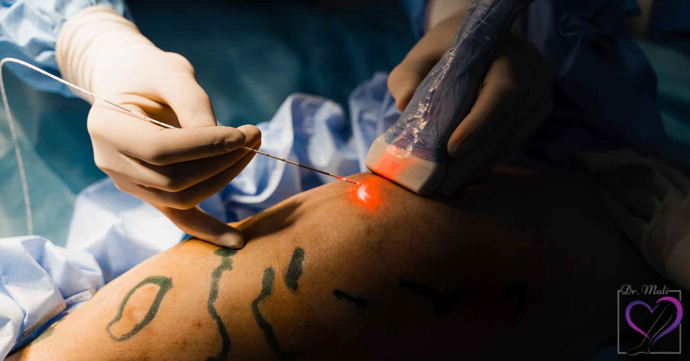 درمان واریس با لیزر چگونه انجام می‌شود؟