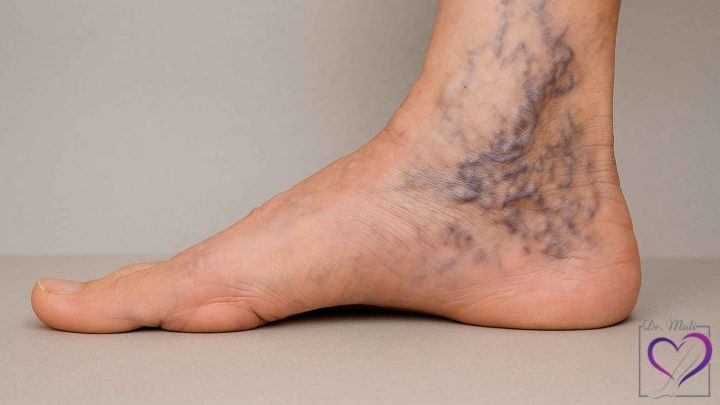 واریس مچ پا