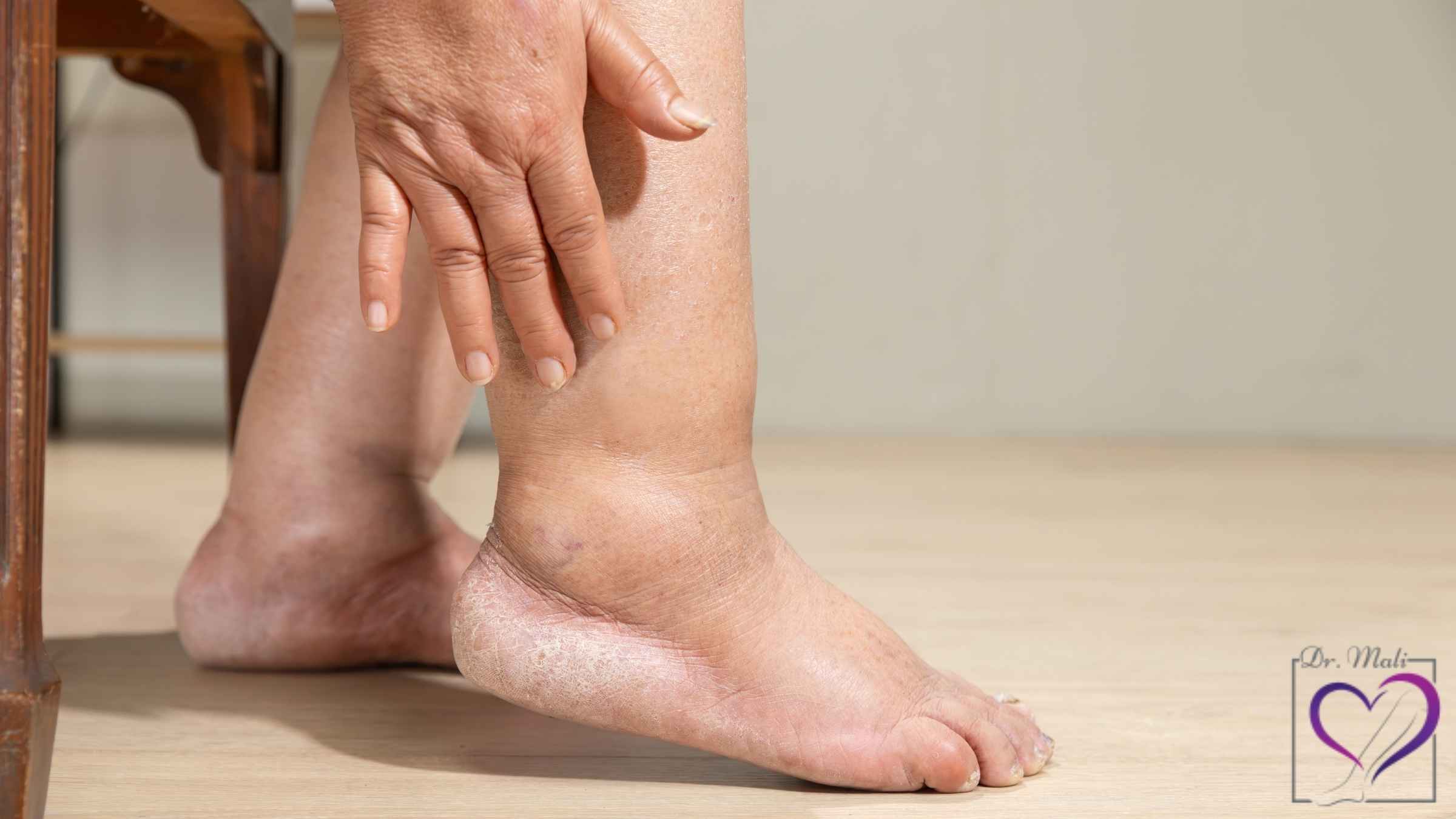 ورم مچ یا ساق پا در پایان روز