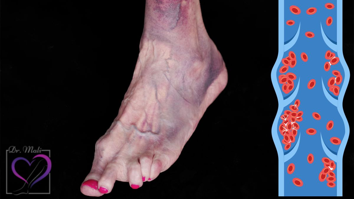 لخته شدن خون در پا چه خطراتی دارد